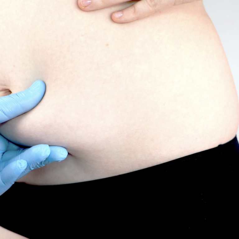 Virginia Beach 360 Liposuction Surgeon